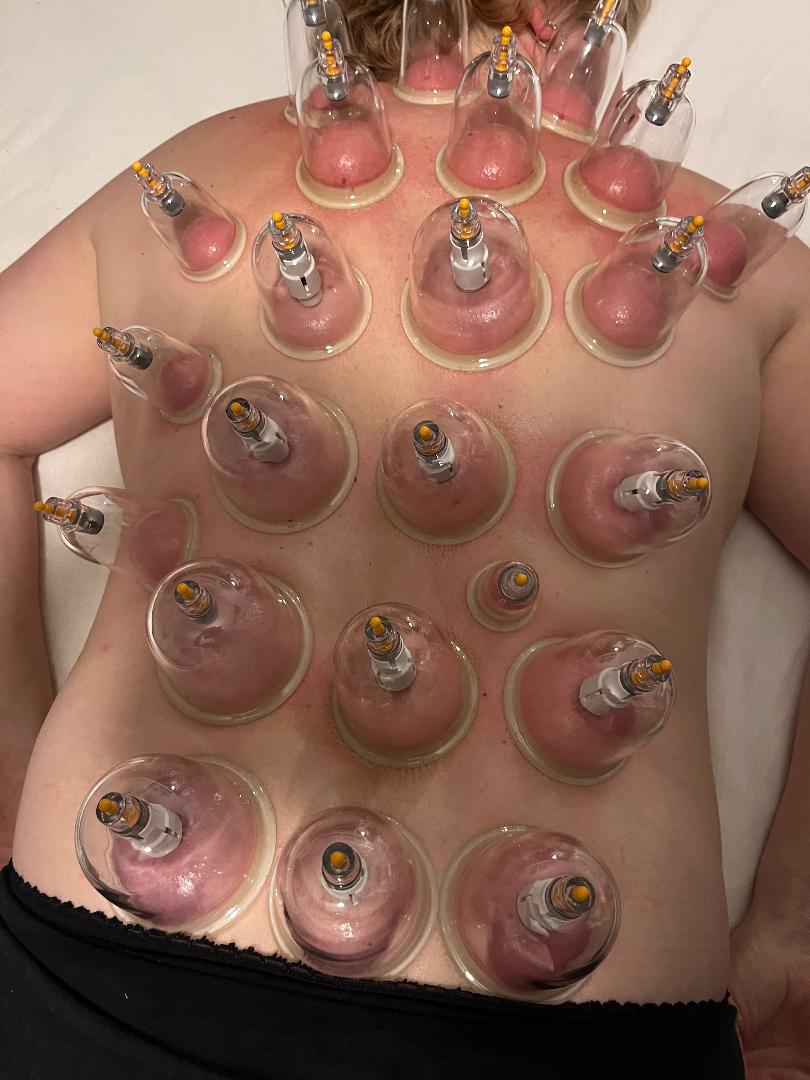 Cupping Salon Naomi Bowtech Akupunktur